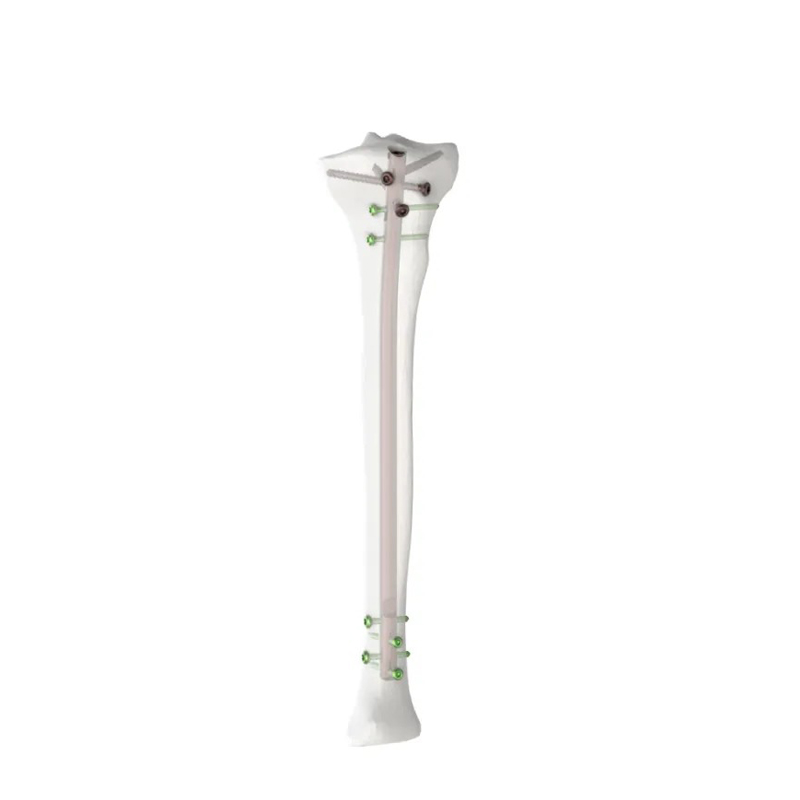 Expert Clou intramédullaire pour tibia | Implant orthopédique en titane