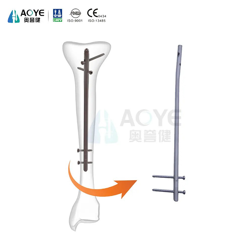 Clou intramédullaire tibial