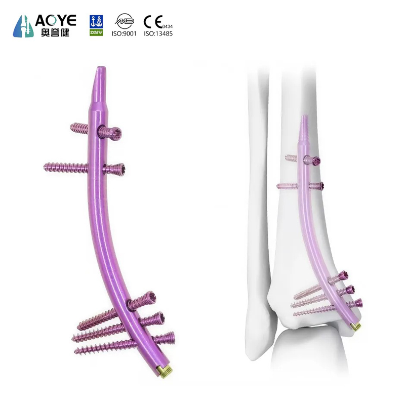 Clou intramédullaire tibial distal (DTN)
